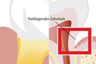 Empfindliche Zähne Empfindliche Zaehne