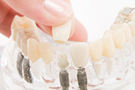 Implantate Zahn + Implantat